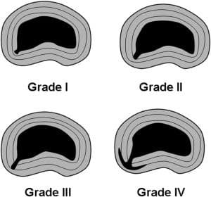 Internal Disc Disruption