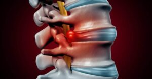 Disc Herniation